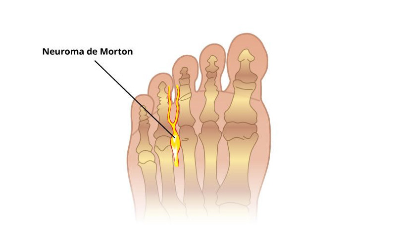 cirugía Neuroma de Morton - Podología Elguezua